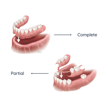 Dentures (Complete and Partial)